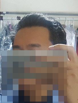M字脱发非切开毛发移植（3000发）约255天
