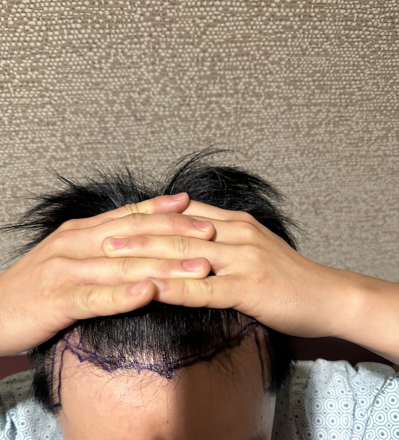 뉴헤어 4일차 절개 모발이식 후기 1600모낭이요