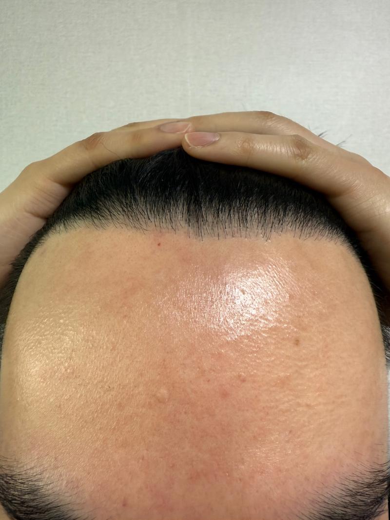 모발이식 331일차