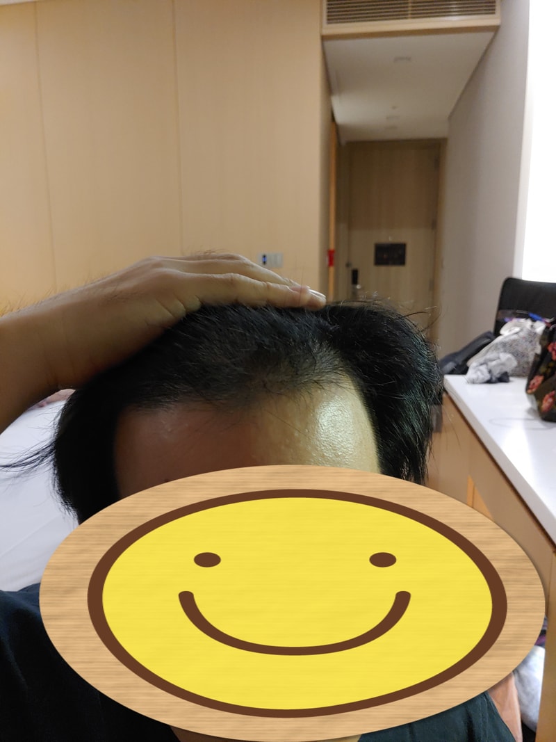I'm in the third month of Modi Hair Aplent surgery