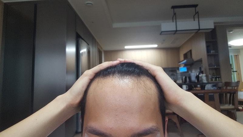 수술전(전).jpg