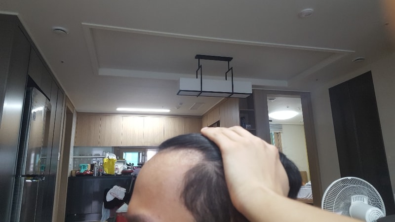 수술전(좌).jpg