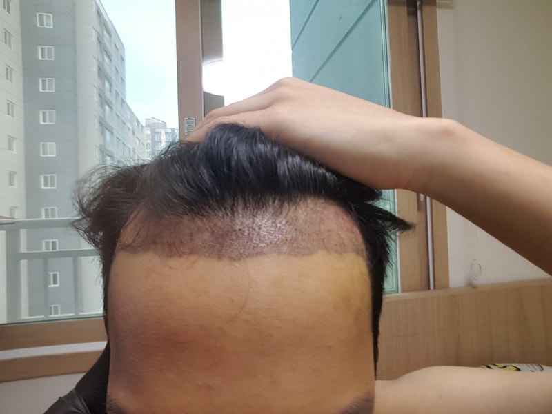수술후(전).jpg