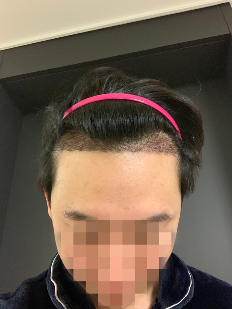 Mo Plus m-shaped cut 2500 Mo 2 weeks ago review