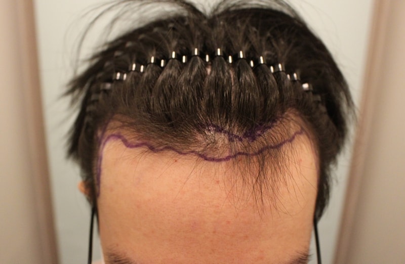Man, M-shaped hair loss, hairline correction, hair transplant, 13 months, results are over!