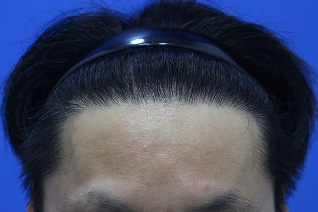 혼용 4000모 이식하고 졸업 합니다! (1년 경과)