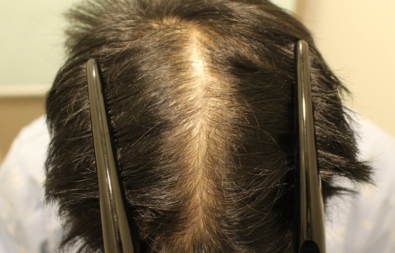 [Dr. M, top of the head for a year] The density of the head