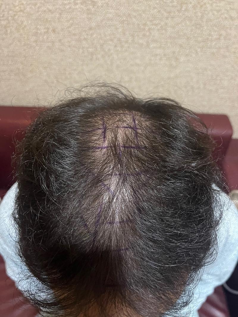 New Hair首尔店/非切开毛发移植/1600毛囊(3200毛)/第7天后期。