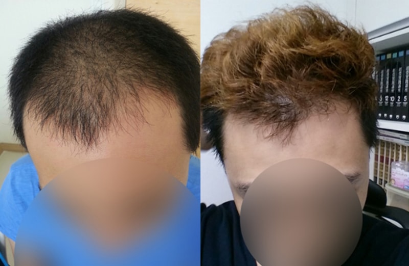 대량이식한지 7개월! 나름 폭풍득모하고 염색까지 해봤습니다!!!