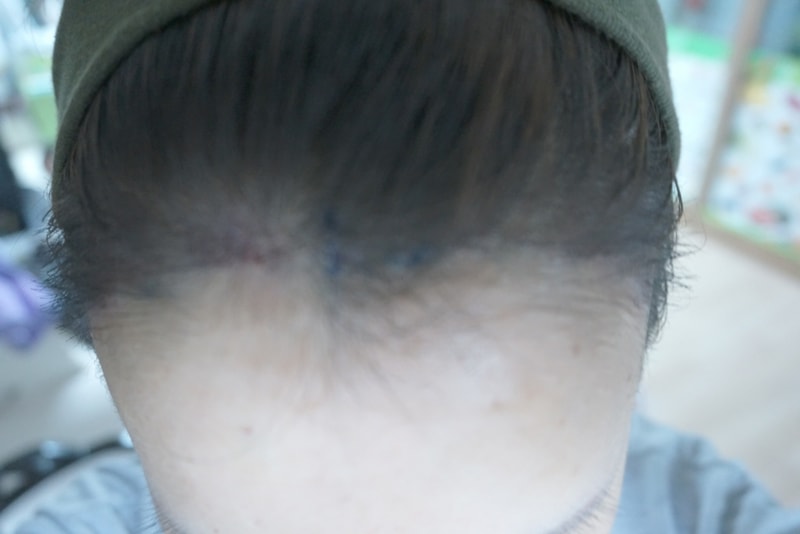 수술당일8.JPG
