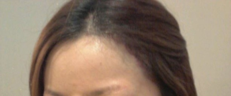 After 2,000 hairline surgery + today is the 13th.