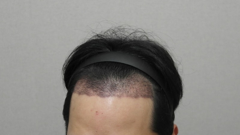 3. 2주 샴푸 후.JPG