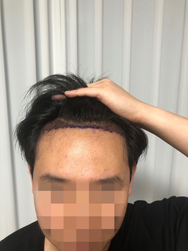 08.이대영_수술3일.jpg