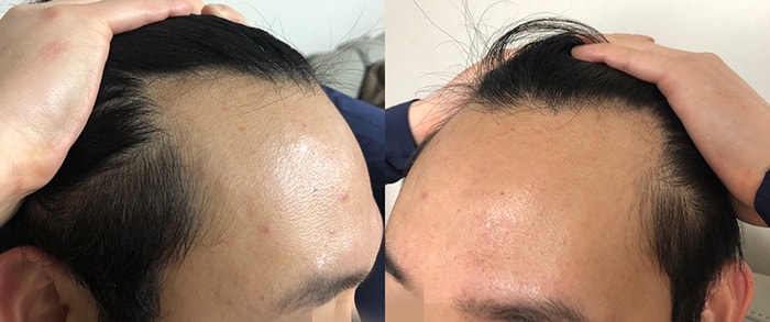 Morplus Plastic Surgery Department m-shaped non-cut 2500 Mo 1 Year Late