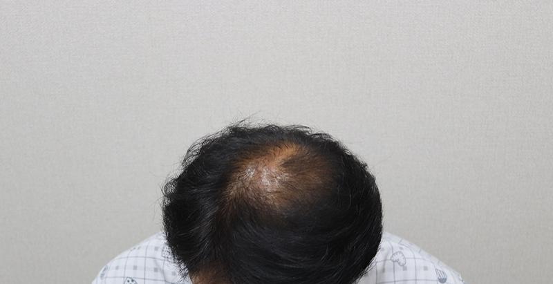 モプラス 整形外科 非切開 4000毛 143日目 レビュー (M+O脱毛 ヘアライン+整数)