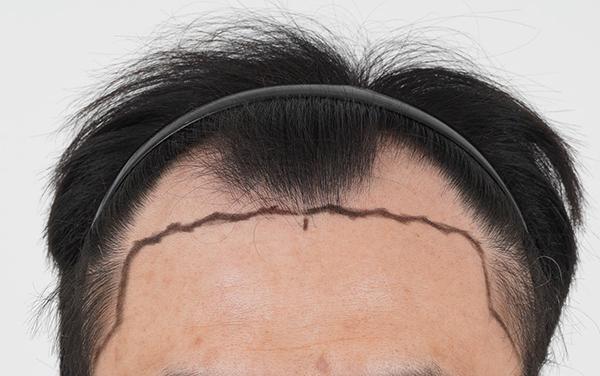 [Busan Momo] Right after the deep M-shaped non-intersected 3800 hair transplant