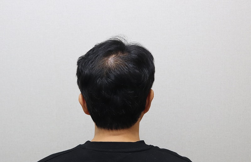 5. 6개월 정수리 IMG_9292.JPG
