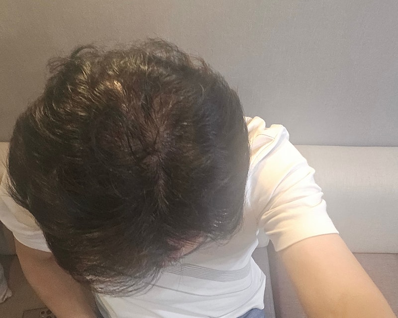 6. 정수리 1년1개월 가르마부위는 안심은거예요.jpg
