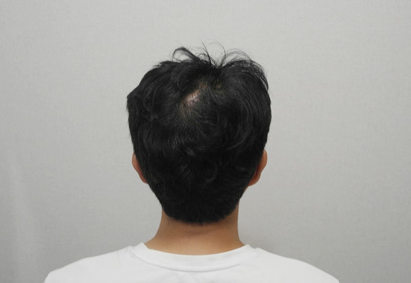 7. 뒤쪽 정수리 1년1개월 경과.JPG