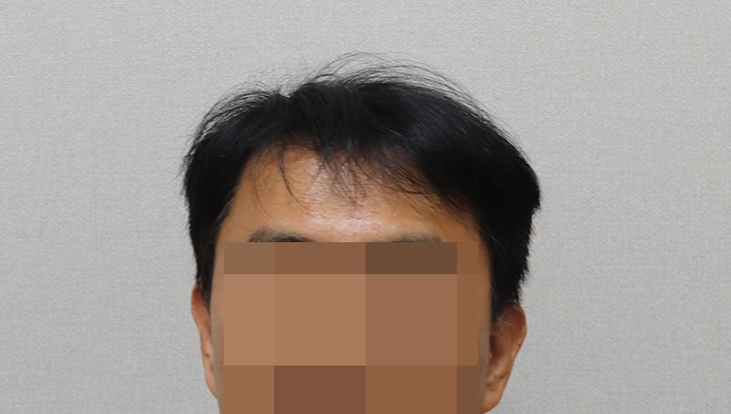 8. 수술전 헤어스타일.JPG