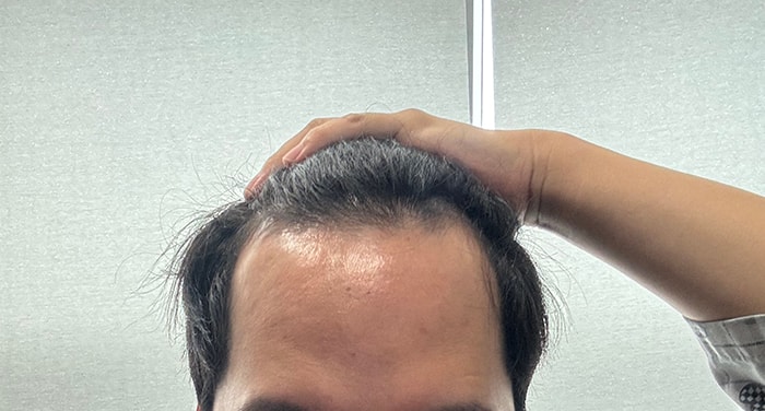 (모플러스 성형외과) 비절개 3800모 4개월 폭풍득모 중