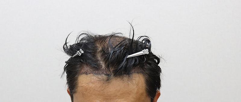 毛プラス 整形外科 非切開 4000毛 2週目のレビュー (M+O脱毛 ヘアライン+整数)