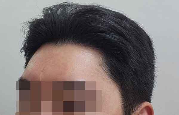 20多岁男性脱发danamoo剃头鼻切开20个月