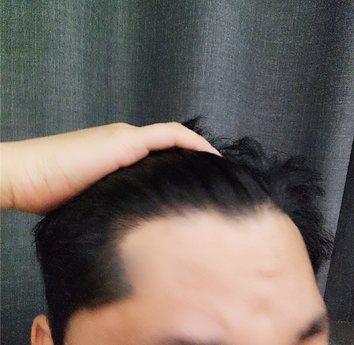新头发移植 10 个月后期
