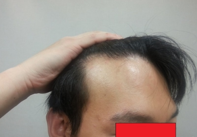 母材性3300本移植1年···して約20日、M字のヘアラインです