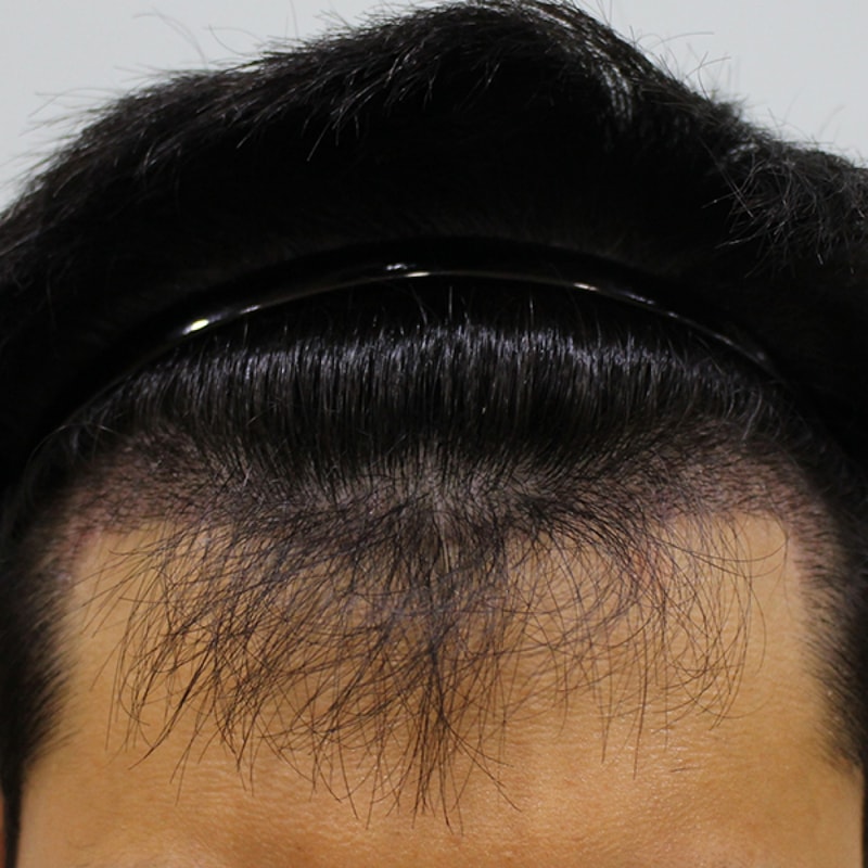 수술후 10일 (9).JPG