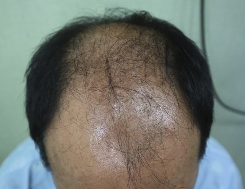 한나이브 절개 3800모 수술 후기