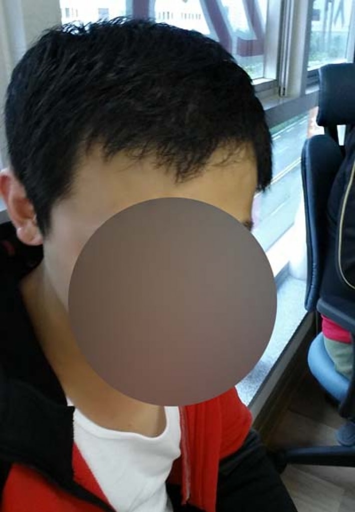 대량이식으로 모발이식 12개월.. 강박증이 생길 것 같습니다 ..ㅡㅡ;