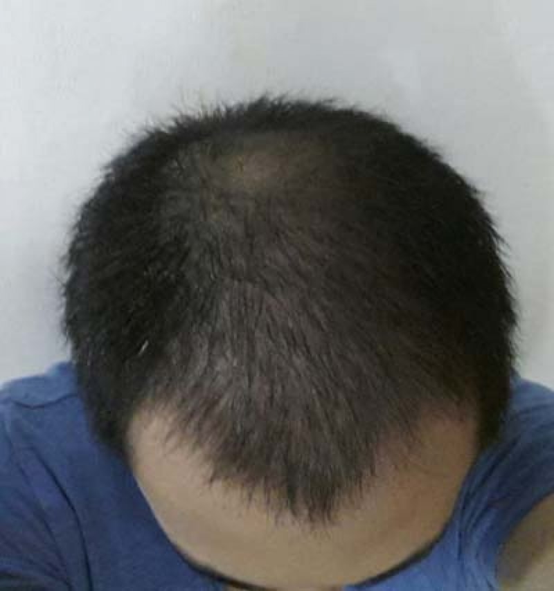 대량으로 모발이식한지 11개월 !! 이제 곧 1년이 다가오네요 ^^