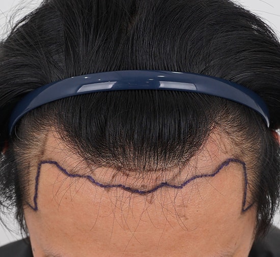 I finally received 3100 non-cutaneous hair transplants.