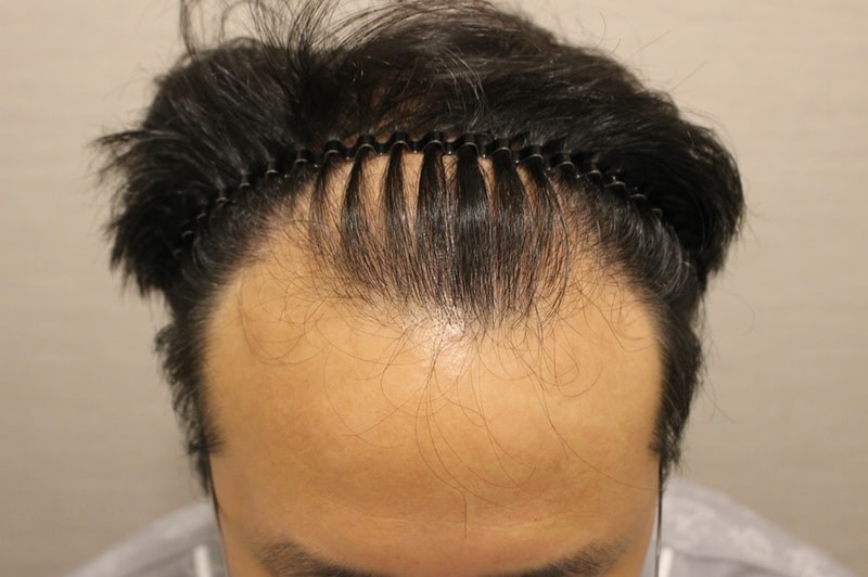 I had a hair transplant due to deep M-shaped hair loss.