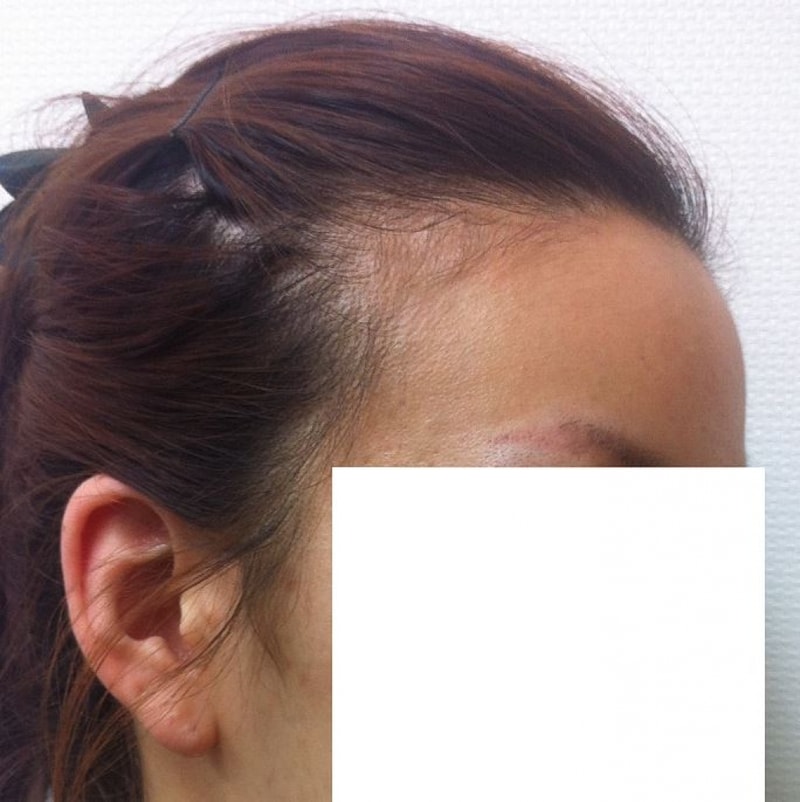 Dana's hairline surgery for a month.