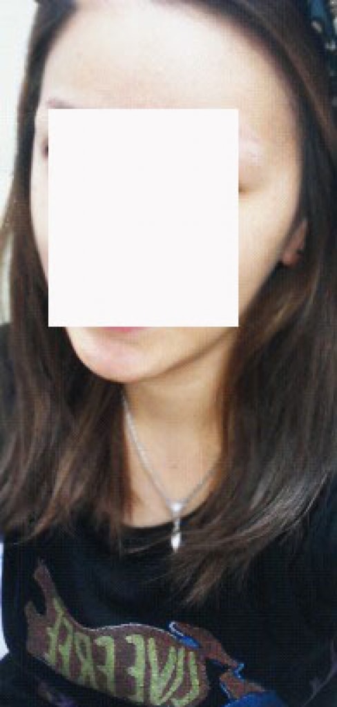 Dana's 2,000-mo hairline correction for 3 months