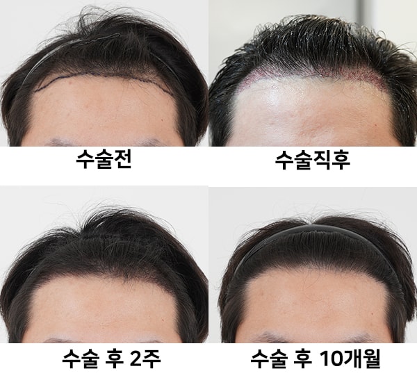 모모 이혜영 원장님께 비절개 모발이식 1000모 10개월 후기