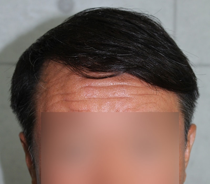 수술후.jpg