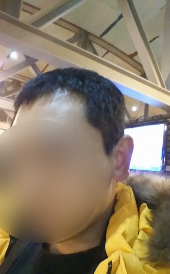 다나성형외과에서 대량이식 5개월째 .....
