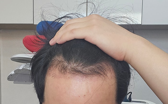 2. 한 70탈락된것같아요 안빠진 머리들은 그대로 자라네요.jpg
