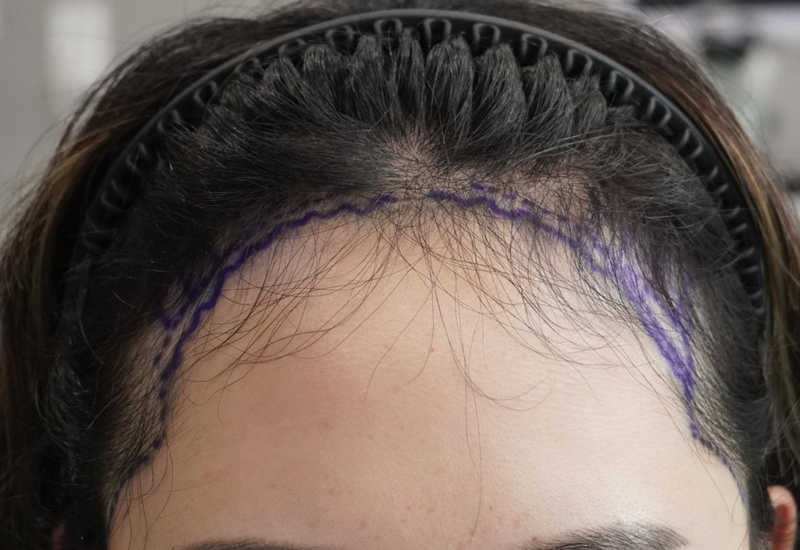グロウ医院(旧ニューヘア釜山店) 非切開女性のヘアライン毛髪移植手術1年目のレビュー(2000本)
