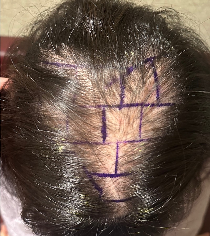 뉴헤어 3개월차 절개 모발이식 후기 / 1700모낭