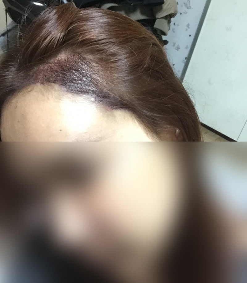 다나에서 헤어라인 받고 왔습니다.