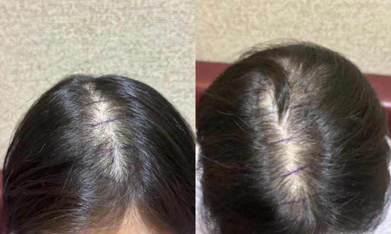 New Hair Seoul Branch Women's Top Head Hair Transplantation incision Day 3