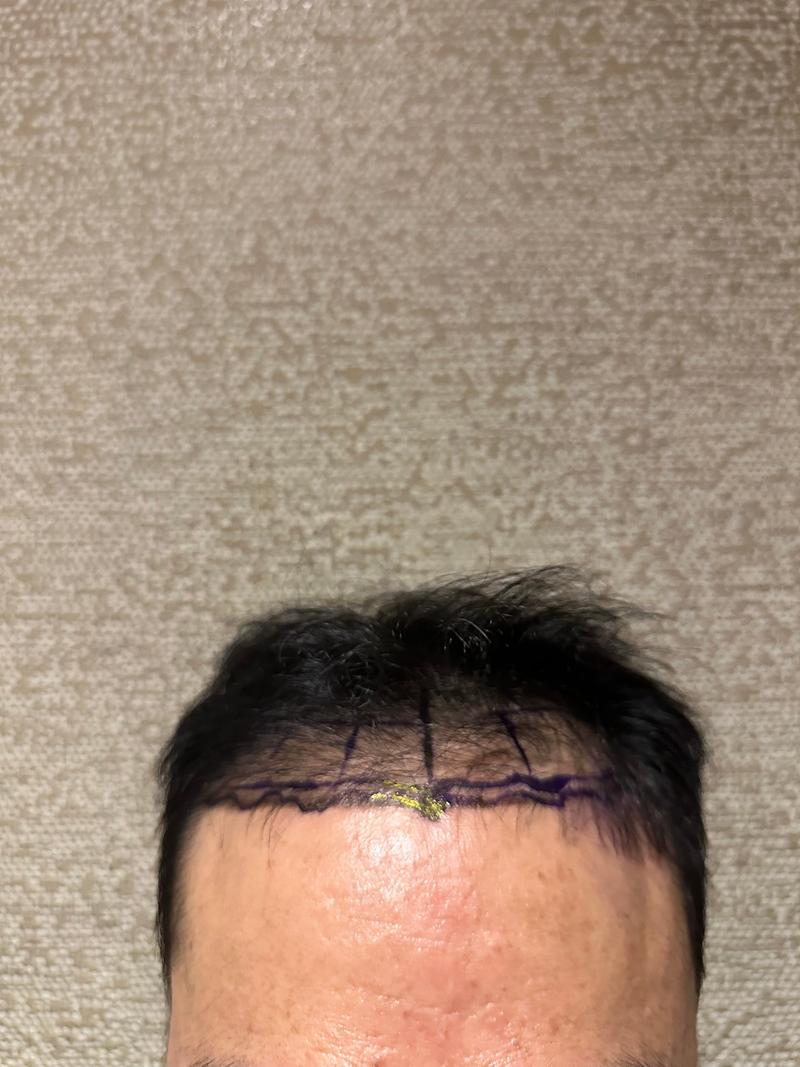 [New Hair] 首尔店 非接缝 毛发移植1500毛囊(3000)毛