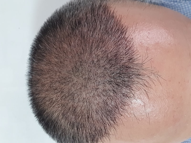 It's the 18th day of Dana 3000 hair follicles.