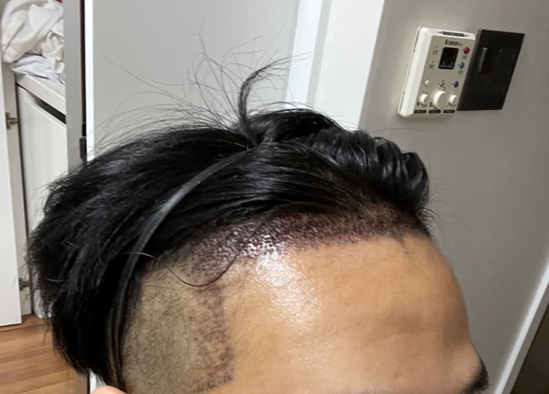 다나 비절개 1800모낭 수술 후기