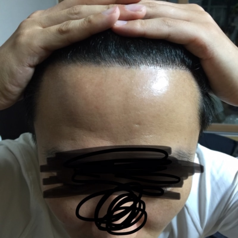 a year after surgery