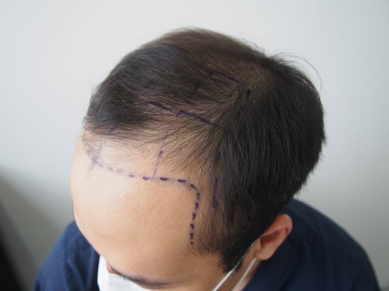 Right after hair transplant 2000 hair follicle surgery